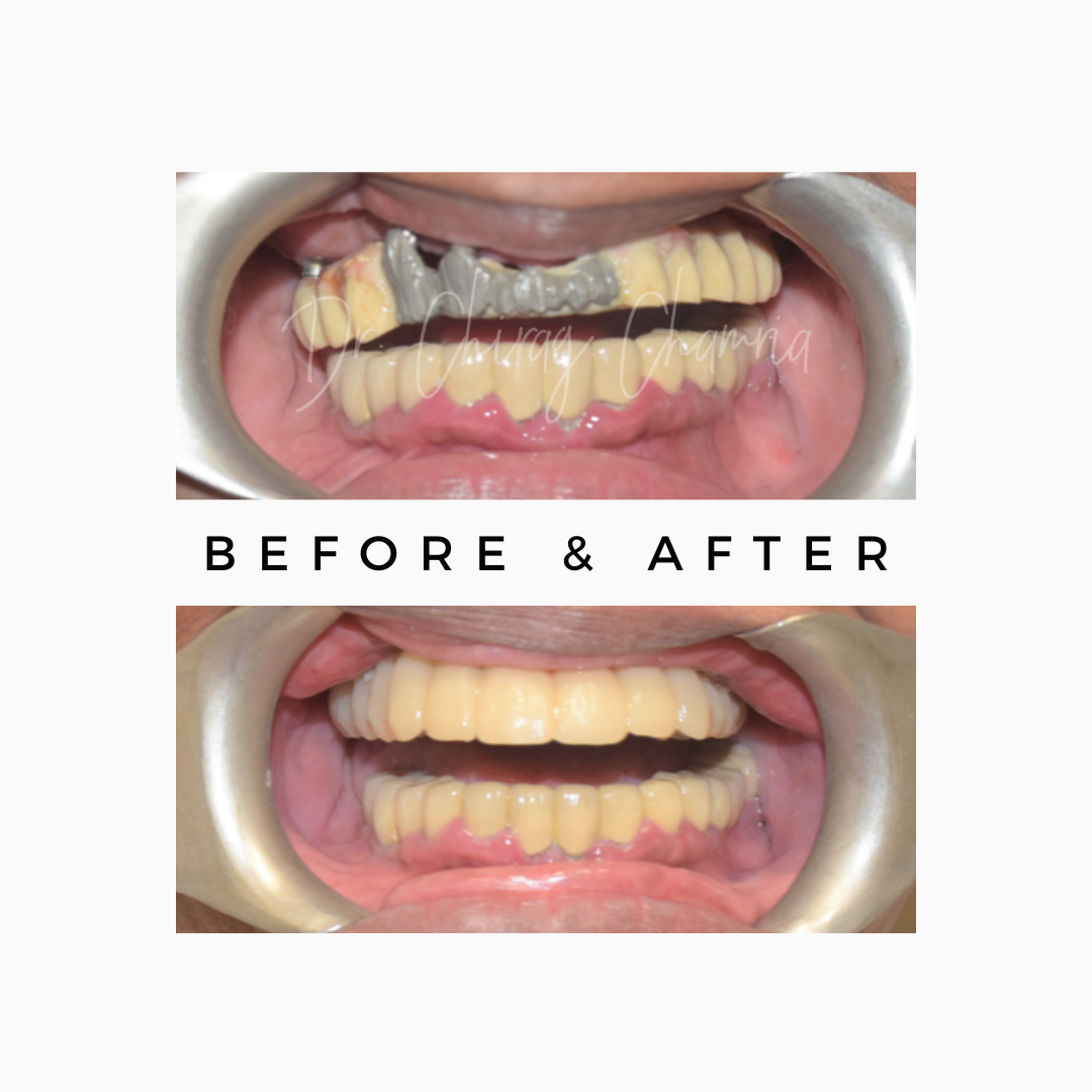 Full Mouth Dentist in India